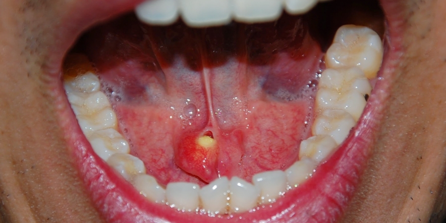 GRAPHIC! Calcium stone pops out of this dudes tongue article image