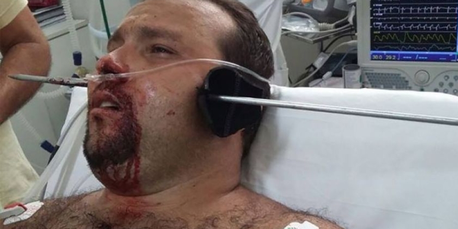 Guy gets speared through the face during illegal fishing trip article image