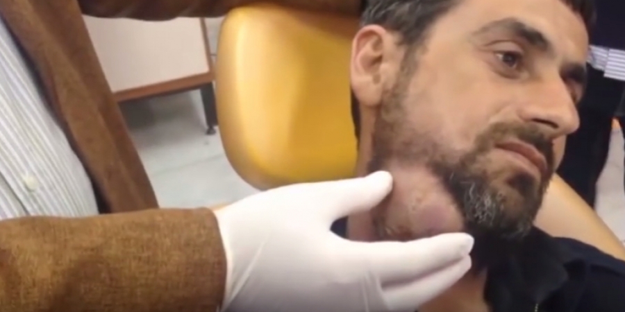 Watching this guys giant abscess being drained will turn your stomach article image