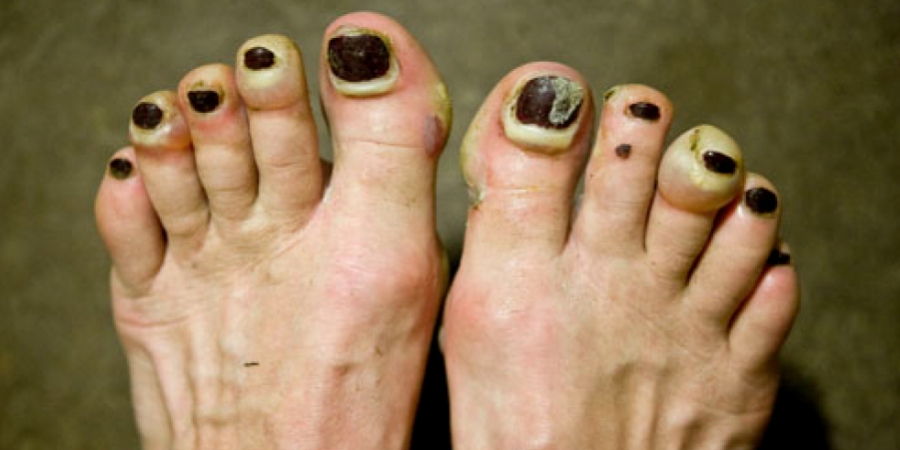 The sight of these hideous feet will definitely put you off your food article image