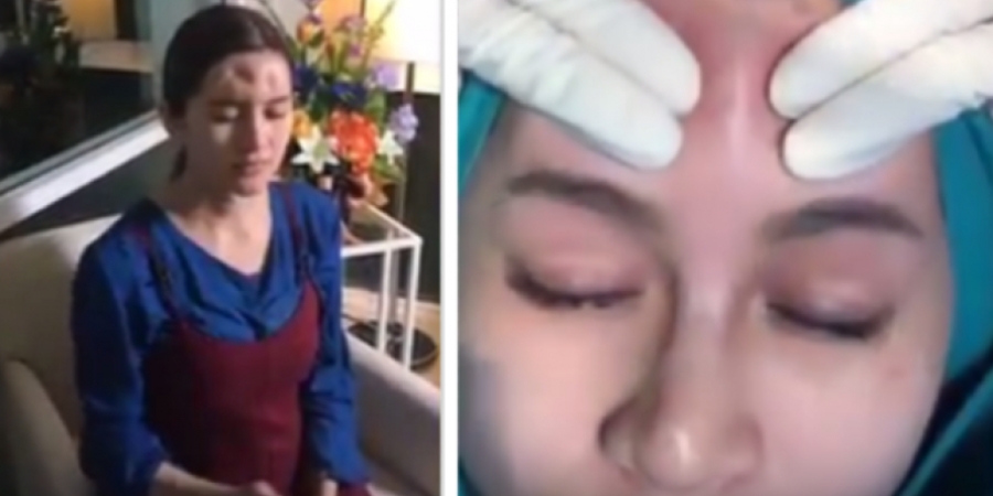 Woman gets infected filler squeezed from her face article image