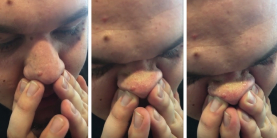 Dudes blackheads popping at the same time looks just like grated parmesan article image