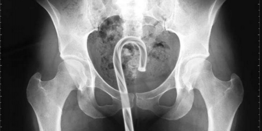 Doctors reveal the weirdest items they've found up patients bums article image