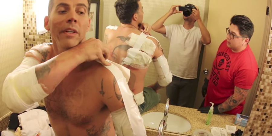 Steve-O suffers horrific burns after stunt goes horribly wrong article image