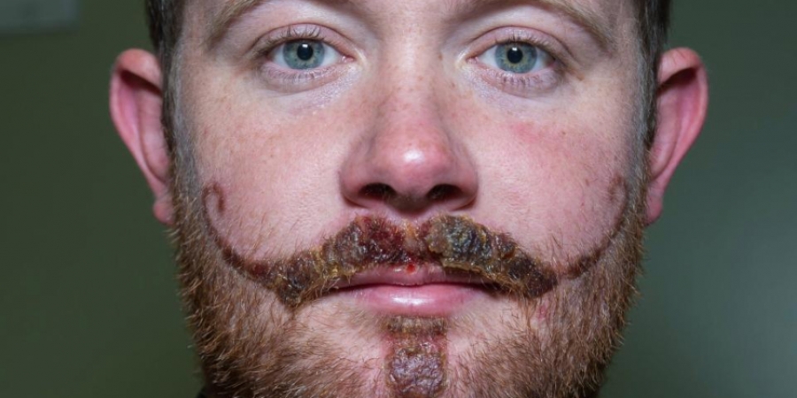 Man left with novelty moustache scar after severe allergic reaction to henna article image