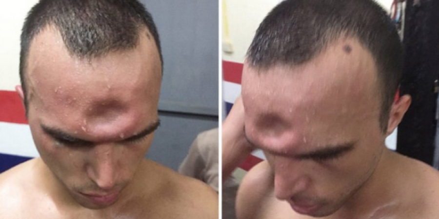 Muay Thai fighter suffers horrendous skull fracture during fight article image