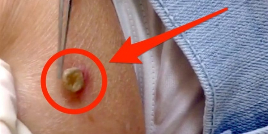 Dr Pimple Popper removes 'growth' that is actually alive!!! article image