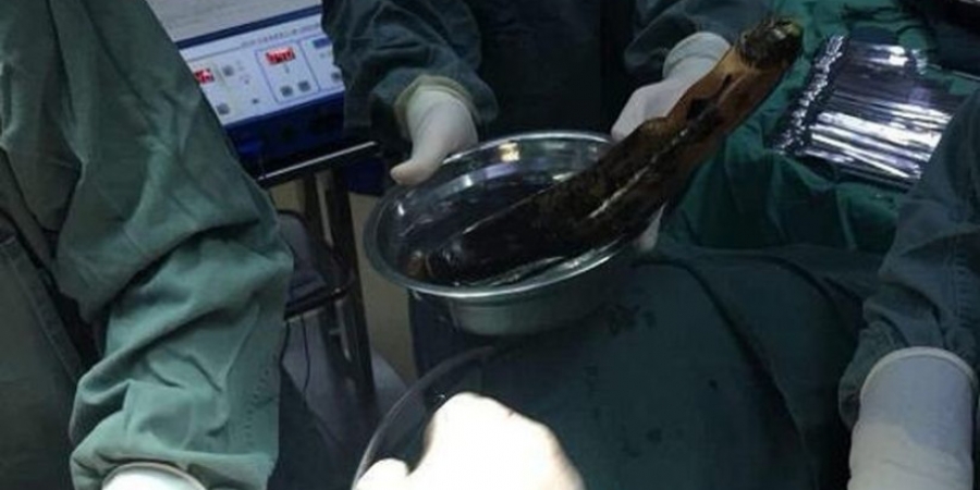 Doctors remove foot-long aubergine from guys intestines after he shoved it up his ass article image