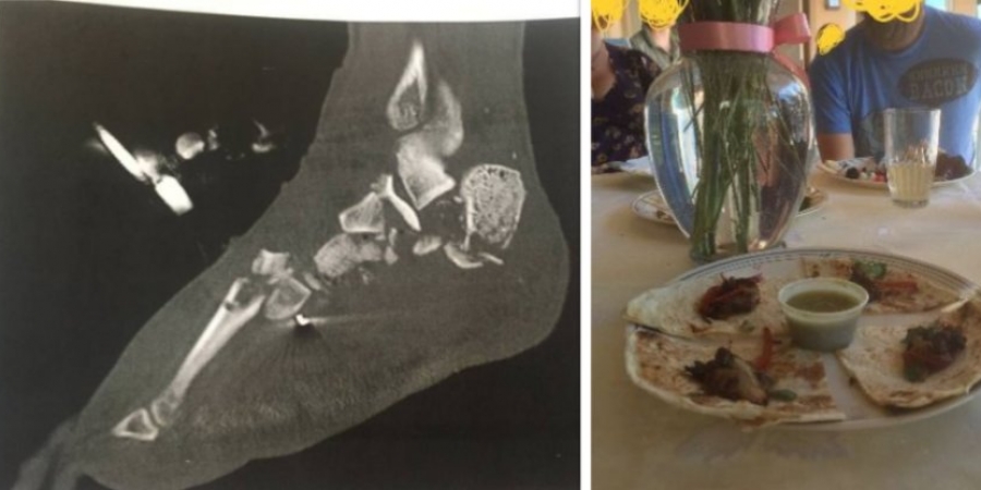 Guy served his mates tacos made from his amputated foot article image