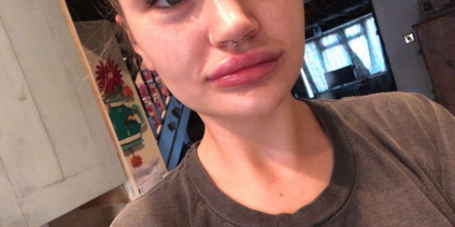 Clinic blames woman's botched lip filler on 'too many blowjobs' article image