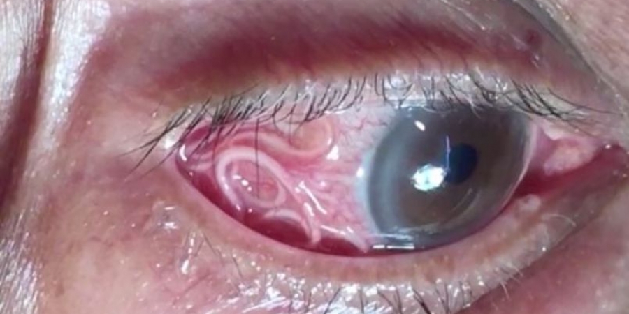 Dude has 15cm parasitic worm pulled from his eye article image