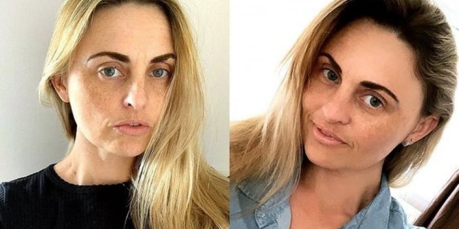 This woman faked depression to get a free nose job on the NHS article image