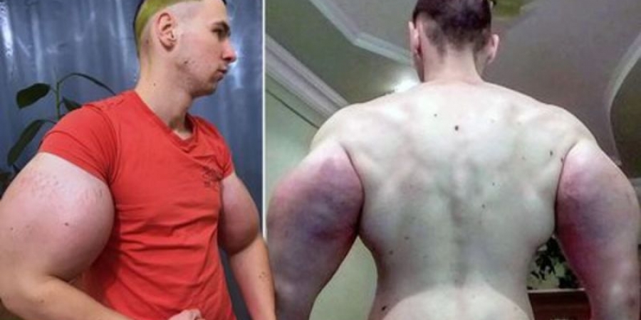 Dude boasts biggest arms in Russia after injecting them with oil article image