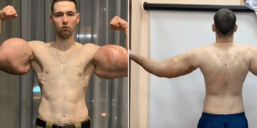 Russian bodybuilder 'Popeye' has 3lbs of rotten muscle removed from his biceps article image