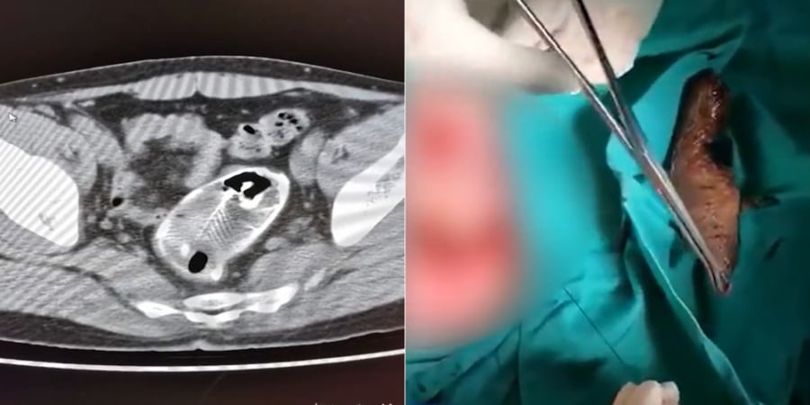 Dude has whole fish removed from rectum after 'accidentally' sitting on it article image